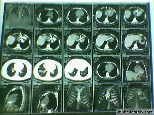 INTRA CARDIAC BULLET WITH INTRA VASCULAR PULMONARY EMBOLIZATION