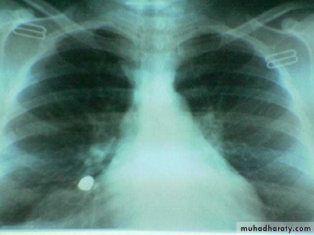 INTRA CARDIAC BULLET WITH INTRA VASCULAR PULMONARY EMBOLIZATION