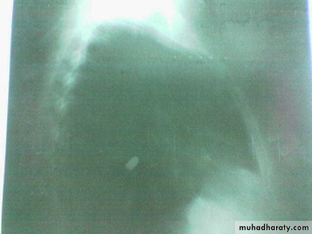 INTRA CARDIAC BULLET WITH INTRA VASCULAR PULMONARY EMBOLIZATION