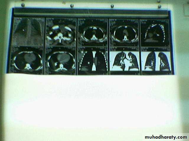 INTRA CARDIAC BULLET WITH INTRA VASCULAR PULMONARY EMBOLIZATION