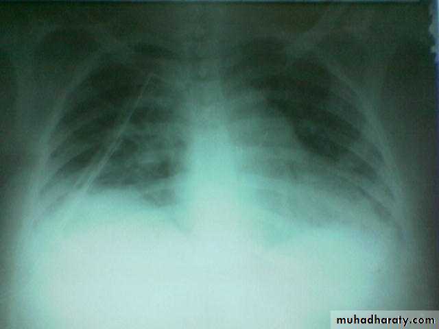 INTRA CARDIAC BULLET WITH INTRA VASCULAR PULMONARY EMBOLIZATION