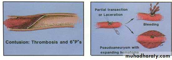 Peripheral Vascular Diseases