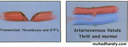 Peripheral Vascular Diseases