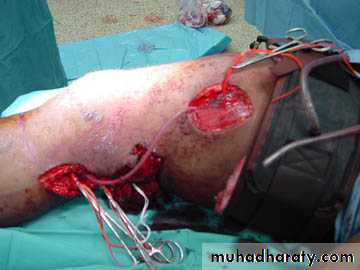 Peripheral Vascular Diseases