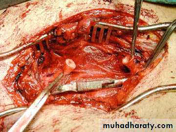 Peripheral Vascular Diseases