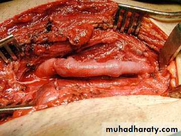 Peripheral Vascular Diseases