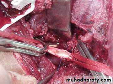Peripheral Vascular Diseases