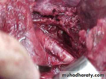 Peripheral Vascular Diseases