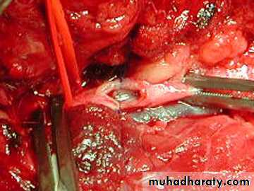 Peripheral Vascular Diseases