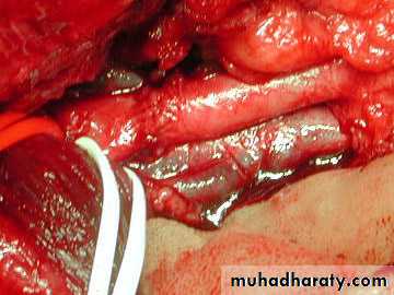 Peripheral Vascular Diseases