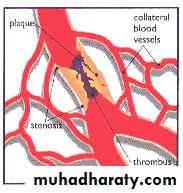 Peripheral Vascular Diseases