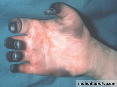 Peripheral Vascular Diseases