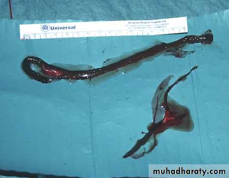 Peripheral Vascular Diseases