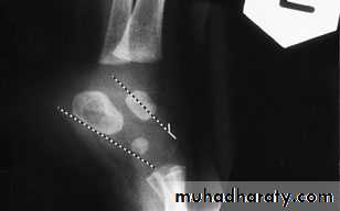foot and ankle deformity