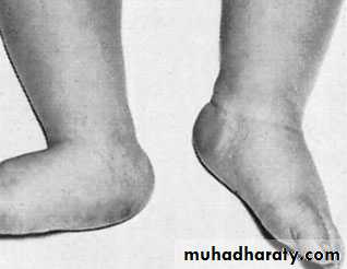 foot and ankle deformity
