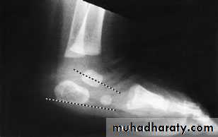 foot and ankle deformity