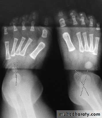 foot and ankle deformity