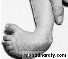 foot and ankle deformity