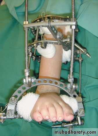 foot and ankle deformity