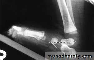 foot and ankle deformity