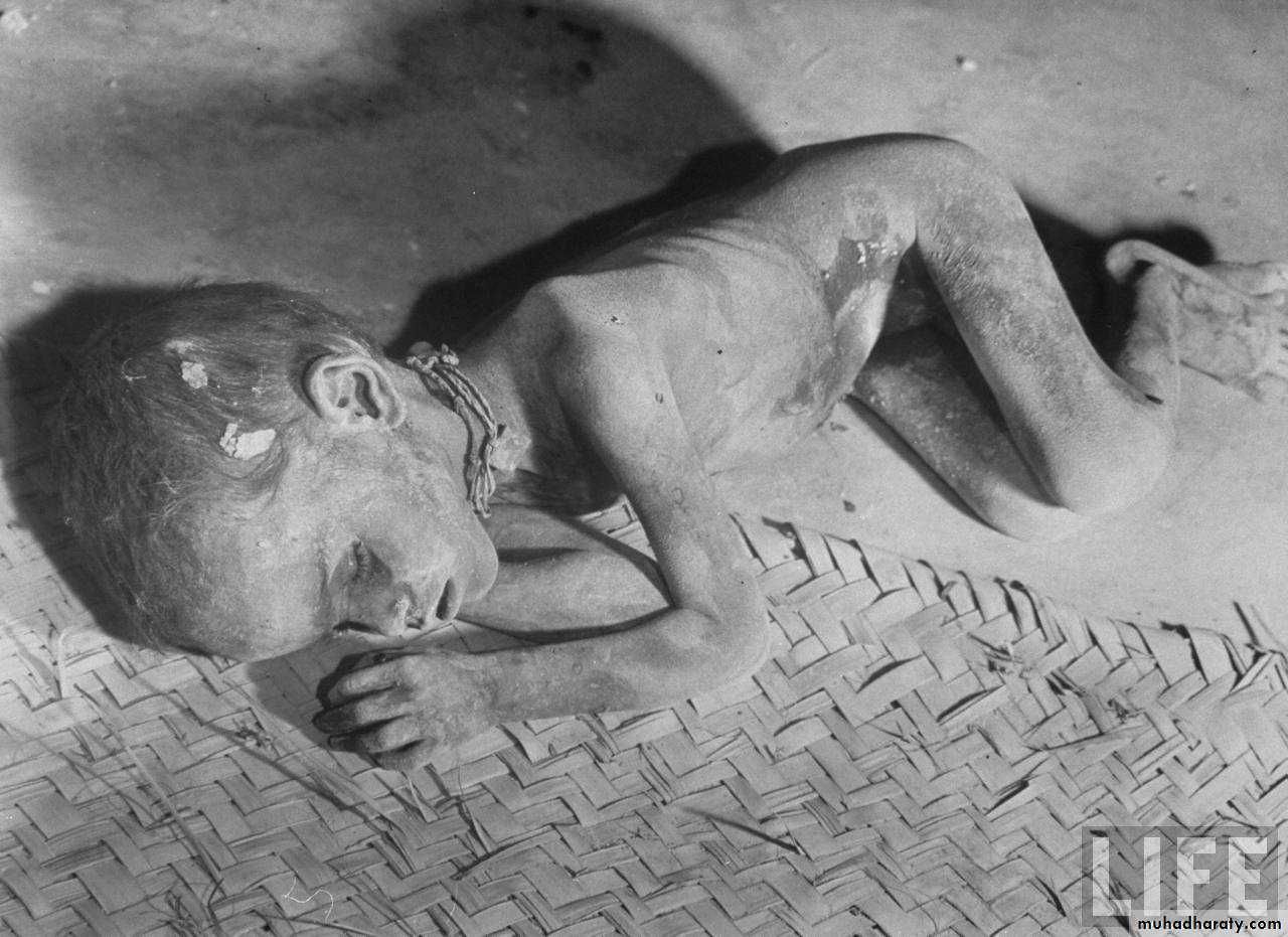 CHOLERA