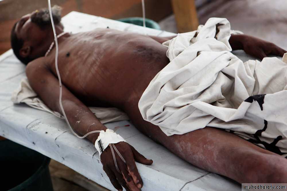 CHOLERA