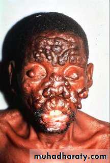 Leprosy
