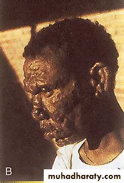 Leprosy