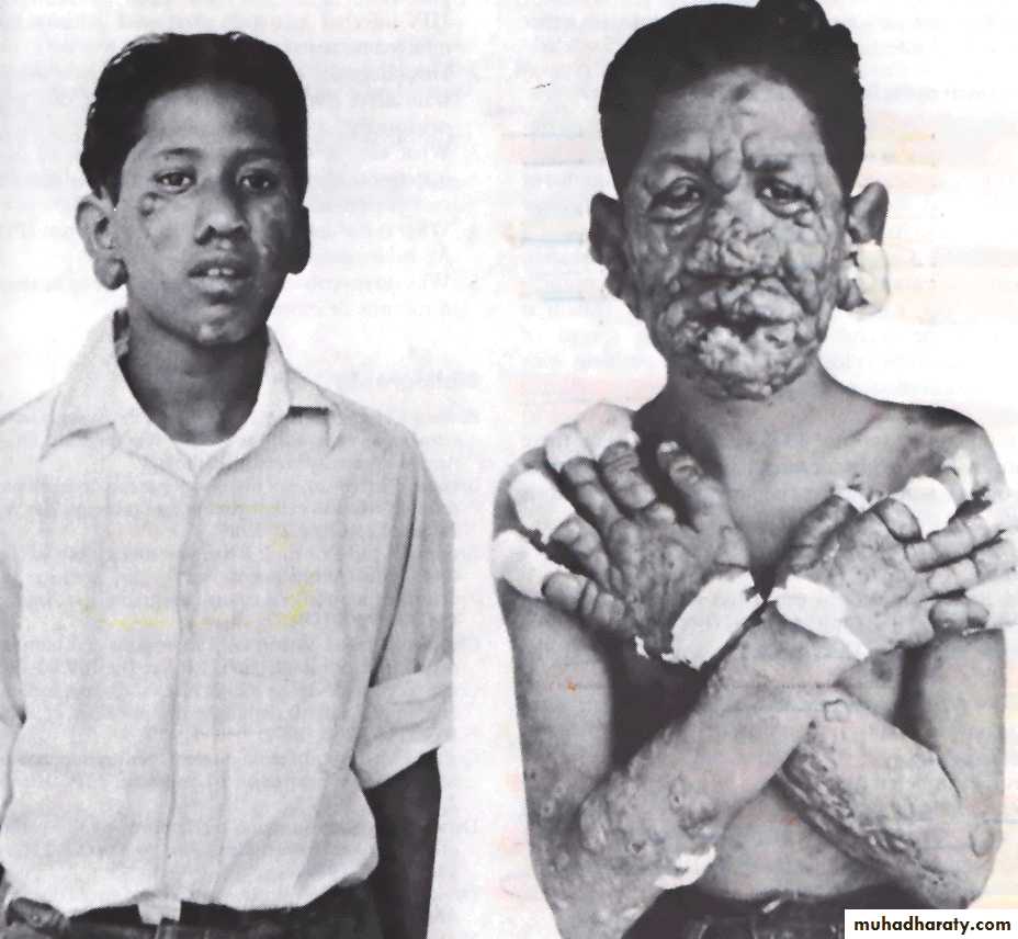 Leprosy