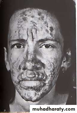 Leprosy