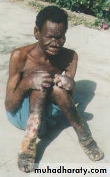 Leprosy