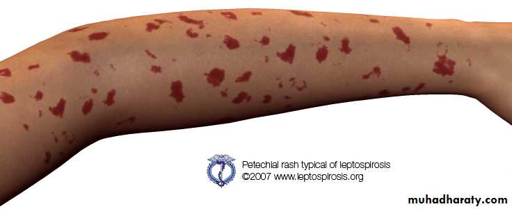 leptospirosis