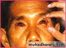 leptospirosis