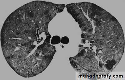 Infection in immuncompromized patient