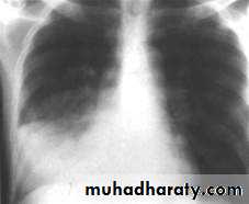 Infection in immuncompromized patient
