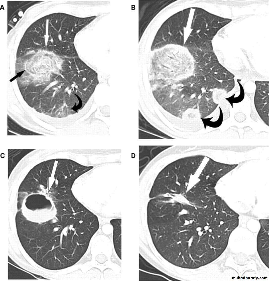 Infection in immuncompromized patient