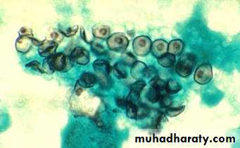 Infection in immuncompromized patient