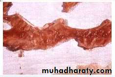 Shigellosis