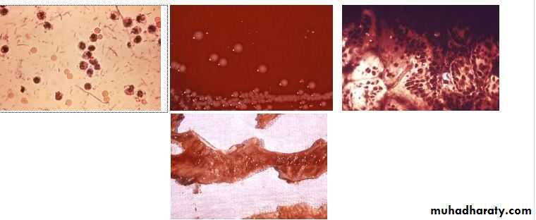 Shigellosis