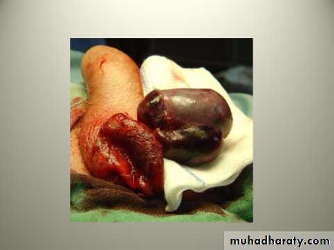 Scrotal Pathologies