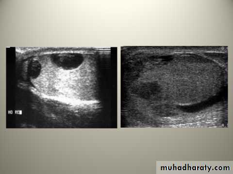 Scrotal Pathologies
