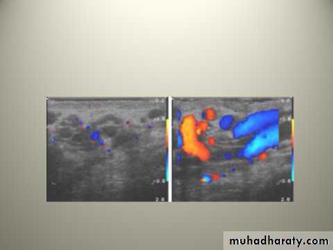 Scrotal Pathologies