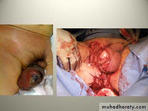 Scrotal Pathologies