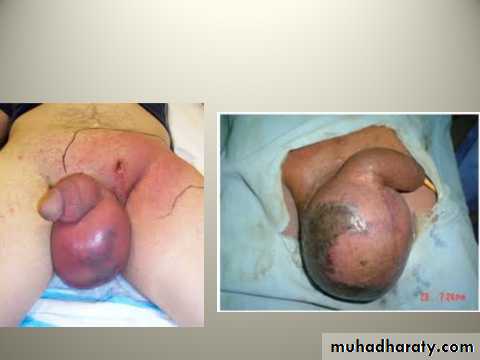 Scrotal Pathologies