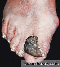 The painful foot