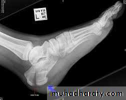 Fracture Talus
