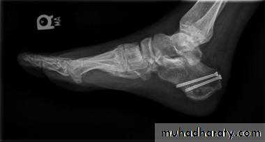 Fracture Talus
