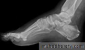Fracture Talus