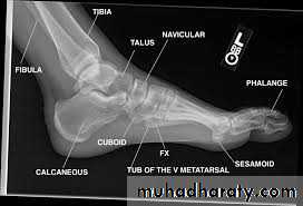Fracture Talus