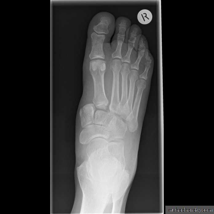 Fracture Talus